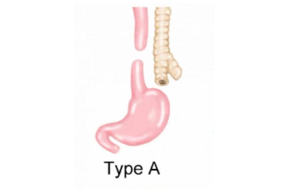 Mengenali atresia esofagus kelainan bawaan pada bayi 