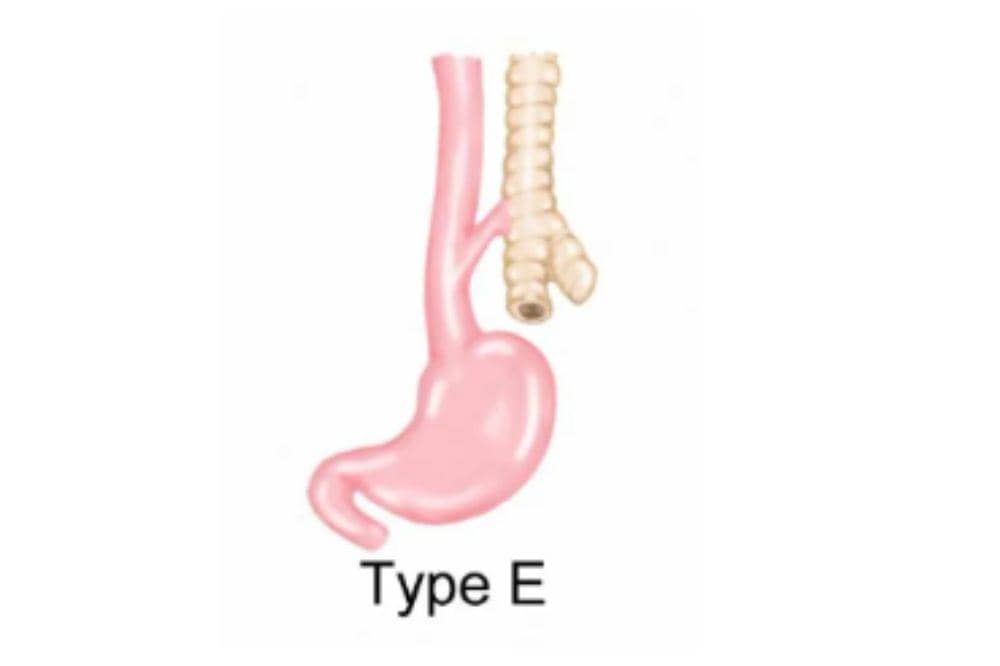 Mengenali atresia esofagus kelainan bawaan pada bayi 