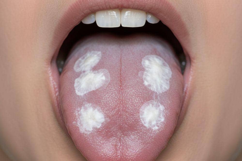 8 Penyebab Lidah Putih pada Orang Dewasa dan Cara Mengatasinya