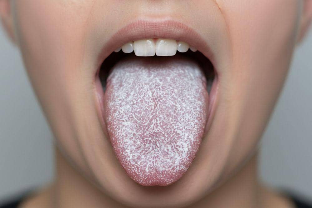 8 Penyebab Lidah Putih pada Orang Dewasa dan Cara Mengatasinya