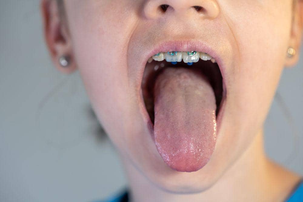 8 Penyebab Lidah Putih pada Orang Dewasa dan Cara Mengatasinya