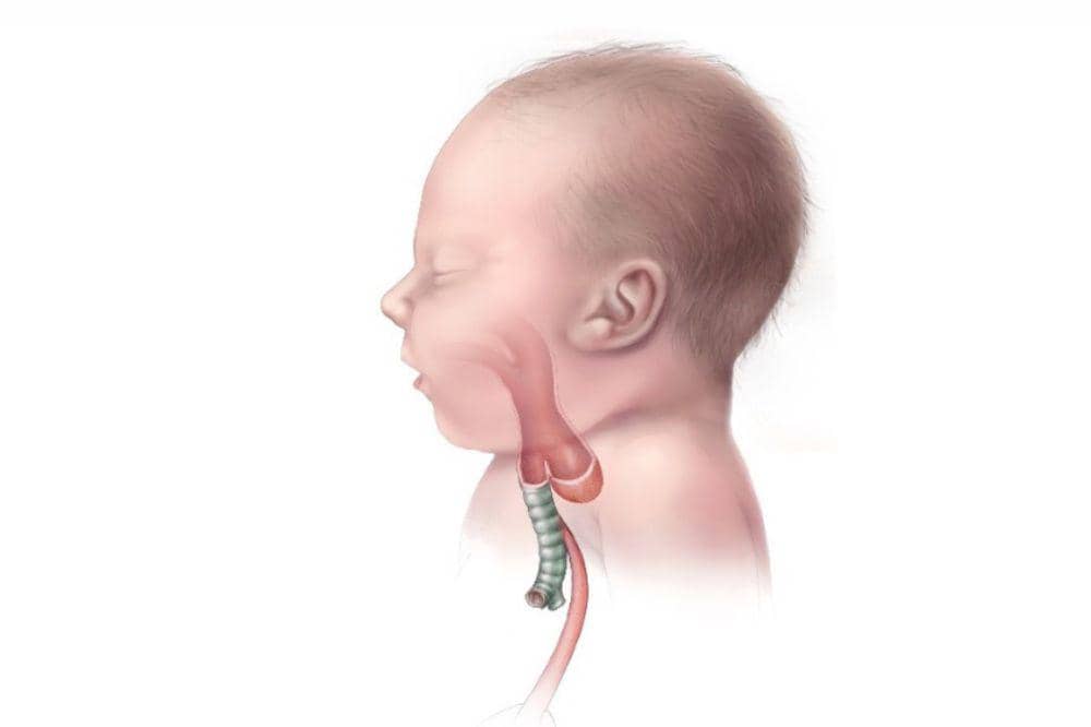 Mengenali atresia esofagus kelainan bawaan pada bayi 