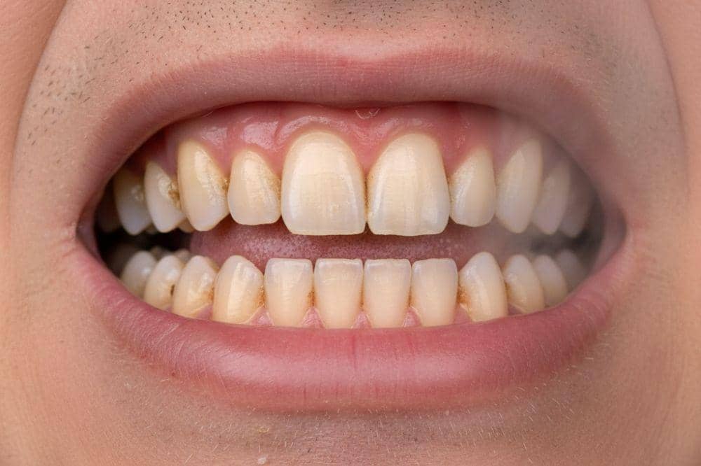 8 Penyebab Lidah Putih pada Orang Dewasa dan Cara Mengatasinya