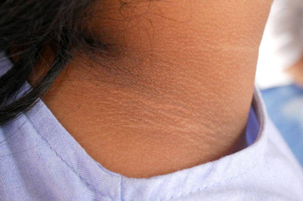 6 Penyebab Leher Hitam yang Jarang Diketahui