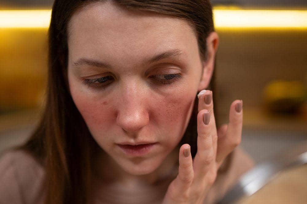 7 Bahaya Memencet Jerawat