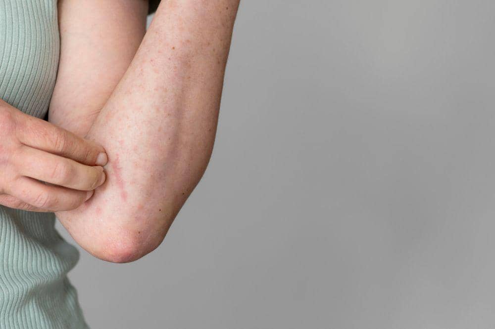 Apakah Campak Boleh Kena Angin? Simak Faktanya