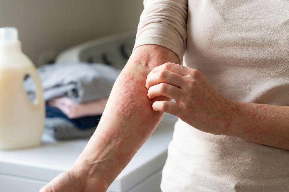 dr. Danar Ungkap Biduran Bisa Jadi karena Pelicin dan Pewangi Pakaian 2