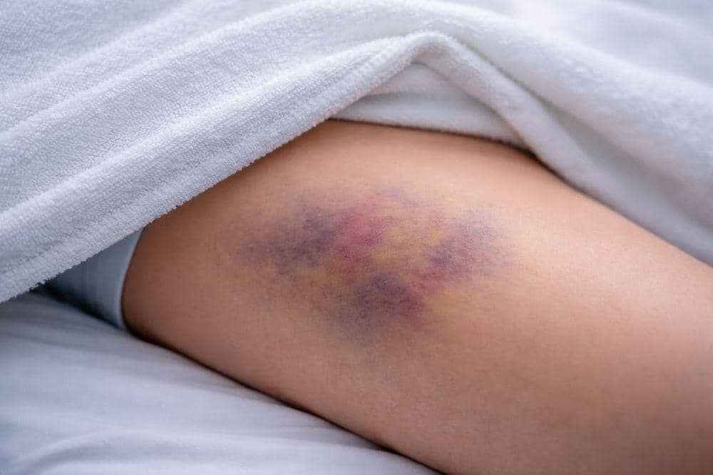 7 Penyebab Memar di Paha, Jadi Tanda Cedera atau Masalah Kesehatan