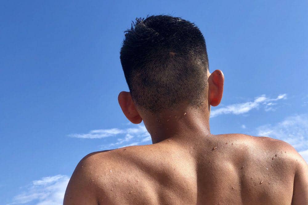 Kenapa Muncul Bruntusan pada Punggung 