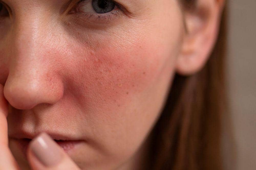 7 Penyebab Kulit Wajah Memerah saat Hamil 7
