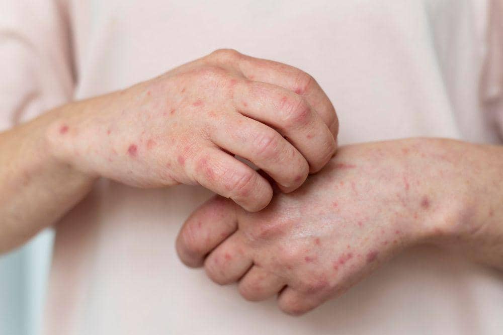 Kasus Campak di Indonesia Tertinggi Kedua di Dunia, Mama Harus Waspada