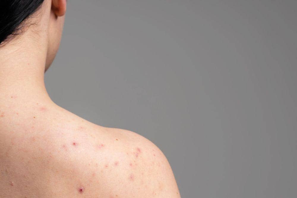 Kenapa Muncul Bruntusan pada Punggung 