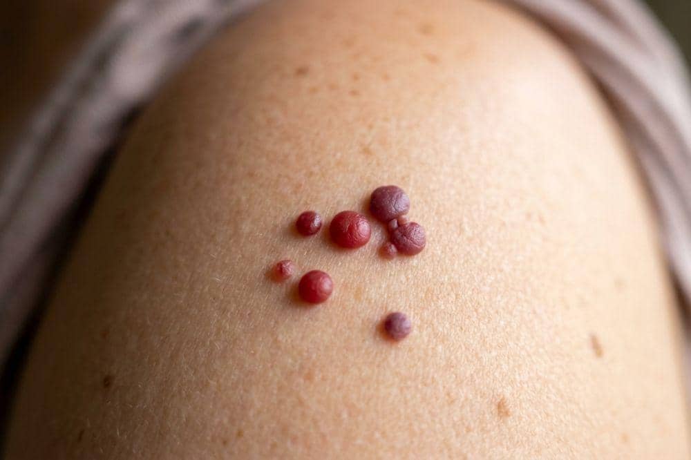 Cherry Angioma: Definisi, Gejala, Penyebab dan Pengobatan