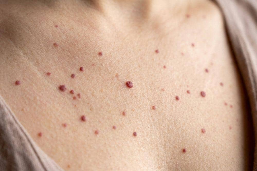 Cherry Angioma: Definisi, Gejala, Penyebab dan Pengobatan