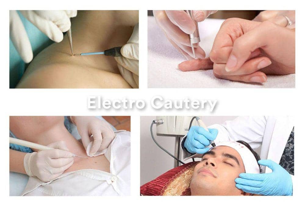 Cherry Angioma: Definisi, Gejala, Penyebab dan Pengobatan