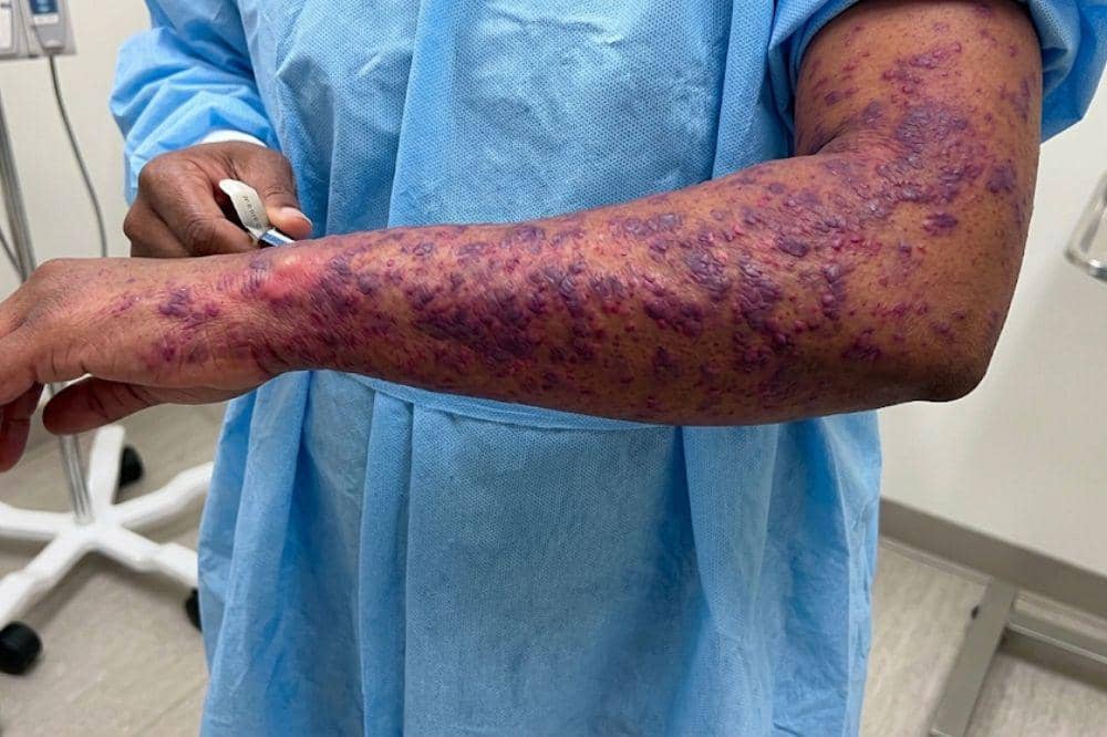 7 Ciri-Ciri Ruam Kulit karena HIV, Kenali Sejak Dini