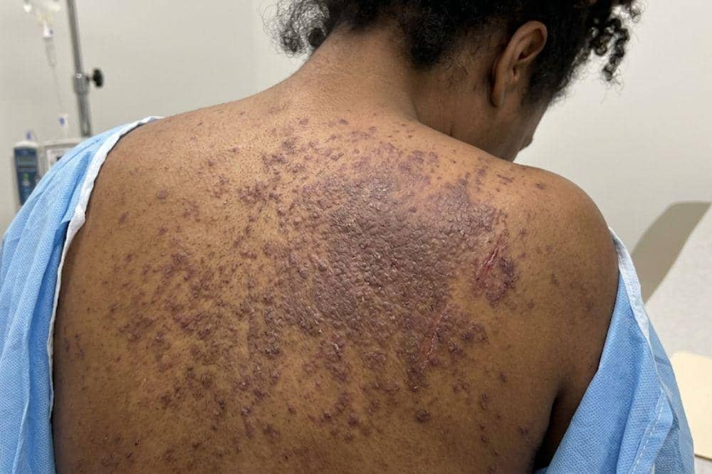 7 Ciri-Ciri Ruam Kulit karena HIV, Kenali Sejak Dini