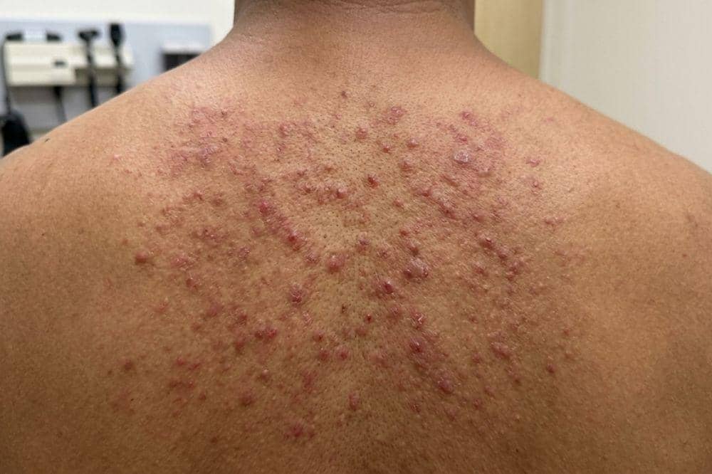 7 Ciri-Ciri Ruam Kulit karena HIV, Kenali Sejak Dini