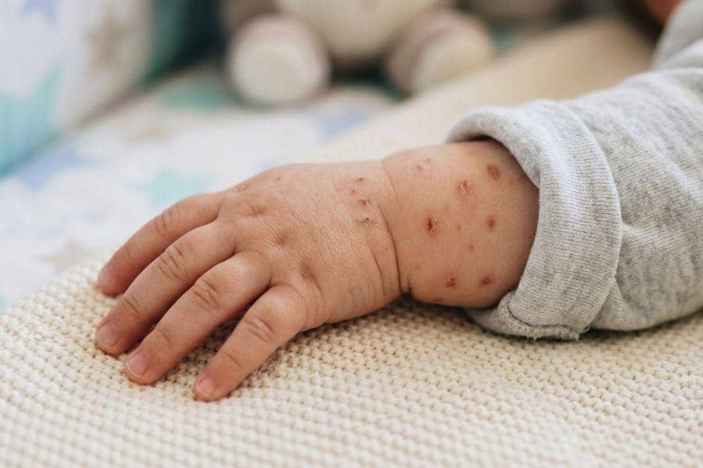 7 Cara Menghilangkan Bekas Campak pada Bayi yang Bisa Mama Lakukan