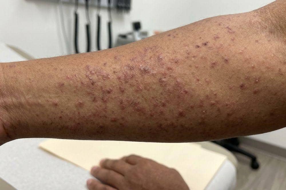 7 Ciri-Ciri Ruam Kulit karena HIV, Kenali Sejak Dini