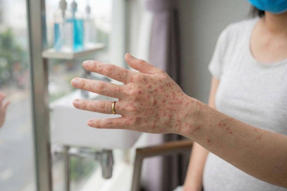 5 Cara Mencegah Campak pada Ibu Hamil, Hindari Kontak dengan Penderita