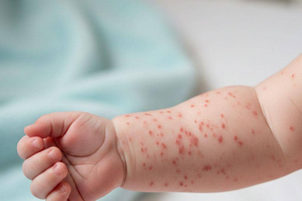 Campak Bisa Meningkatkan Risiko Pneumonia, Orangtua Harus Waspada!