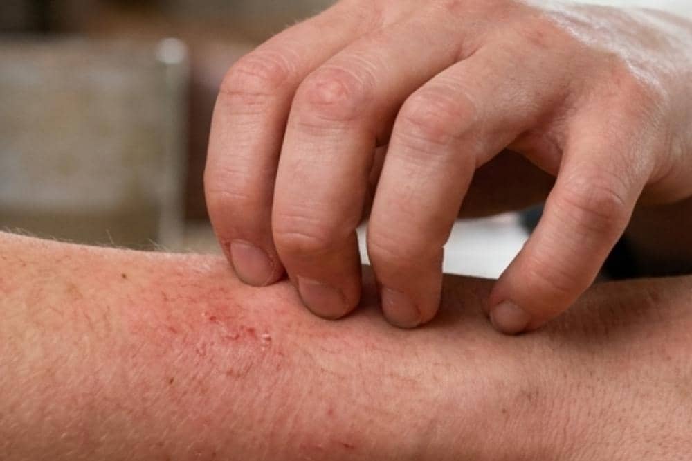 Kamitetep Berasal dari Mana_ Sering Menyebabkan Kulit Gatal_20260311_090121_0001.jpg