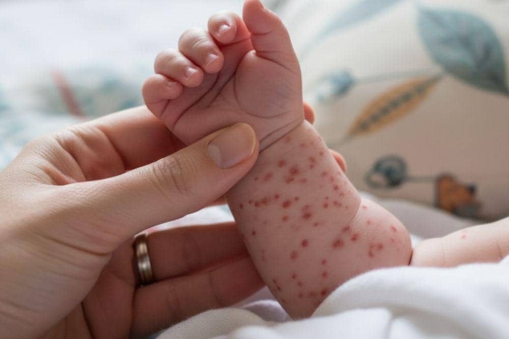 7 Cara Mencegah Campak pada Bayi yang Perlu Mama Ketahui