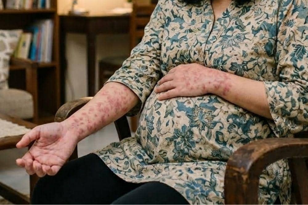 Ibu Hamil Kena Campak, Janin Berisiko Buta dan Tuli