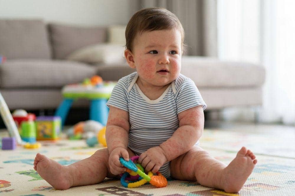 Ketahui Dosis serta Cara Pemberian Vitamin A pada Anak Campak