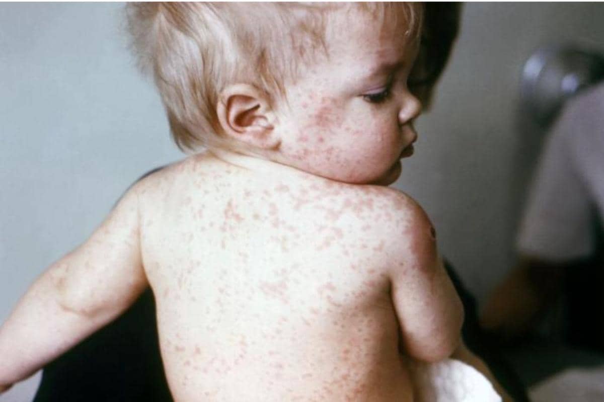 Roseola/Wikipedia