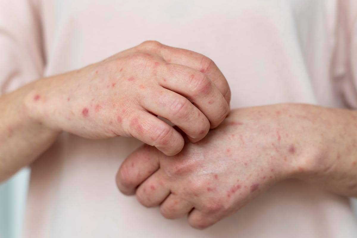 gambar tangan terkena campak