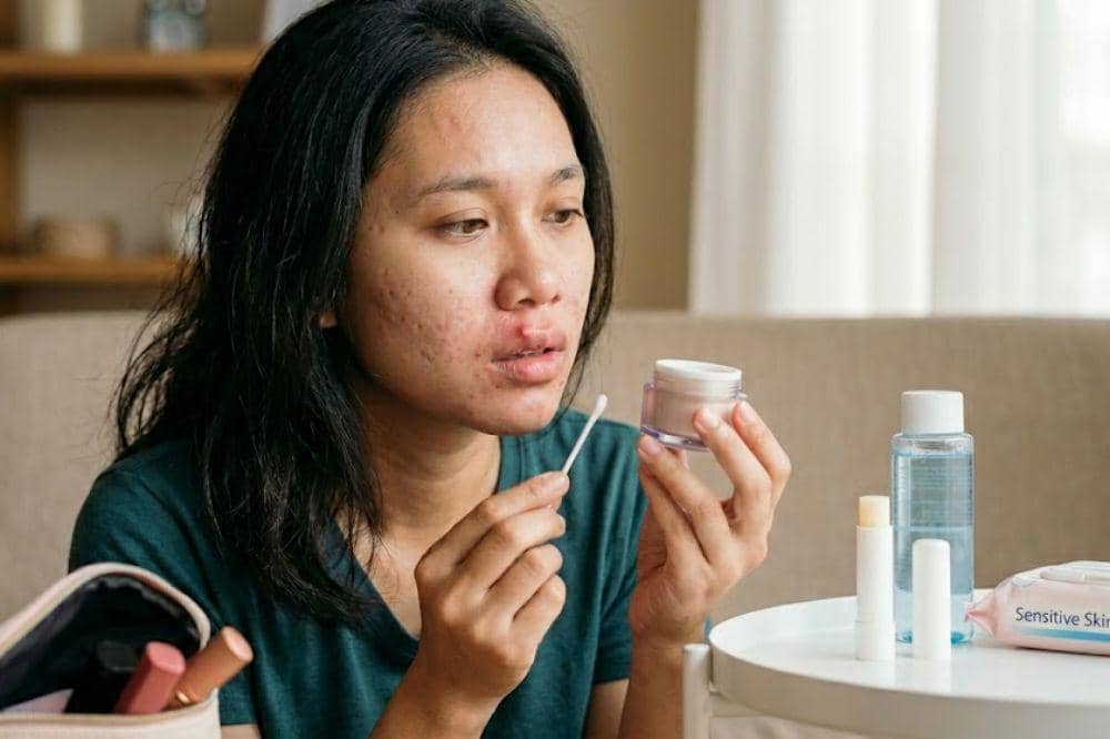 Cara Mengatasi Jerawat di Bibir