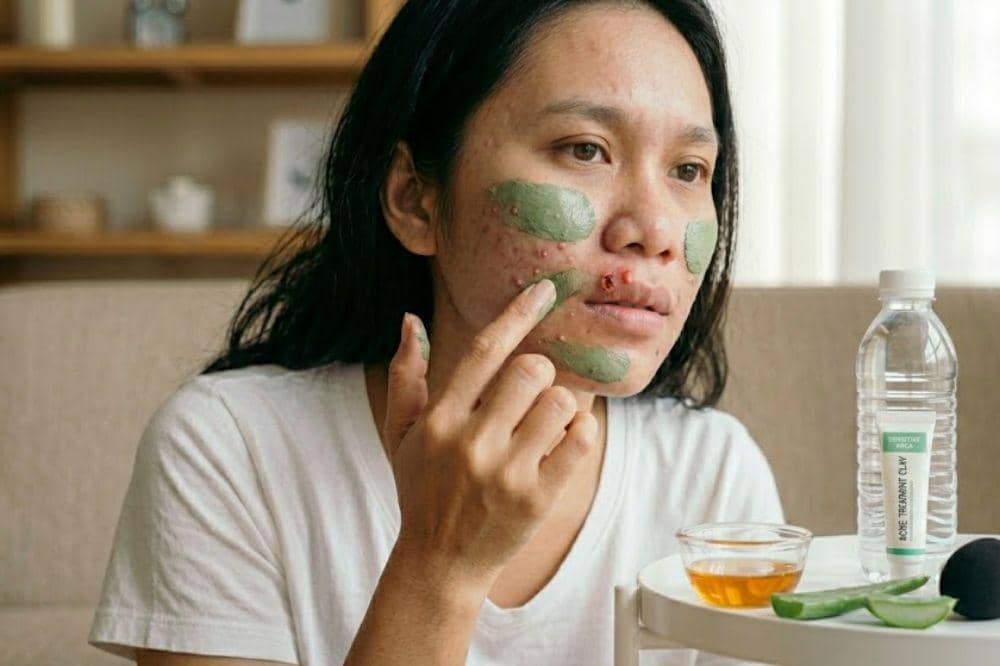 Cara Mengatasi Jerawat di Bibir