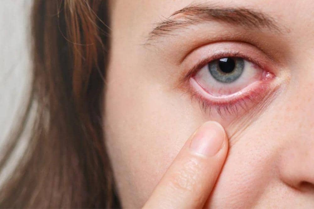 Remaja Terkena Glaukoma sejak Kelas 9 SMP Akibat Sering Konsumsi Maniss, Awasi Pola Makan!