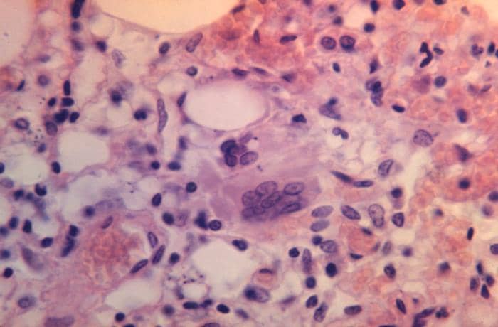 CDC/Public Health Image Library (PHIL)