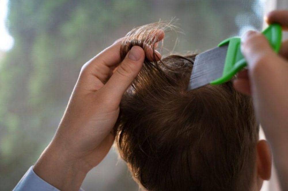 Waspadi 5 Gejala Anak Tertular Kutu Rambut Setelah Liburan