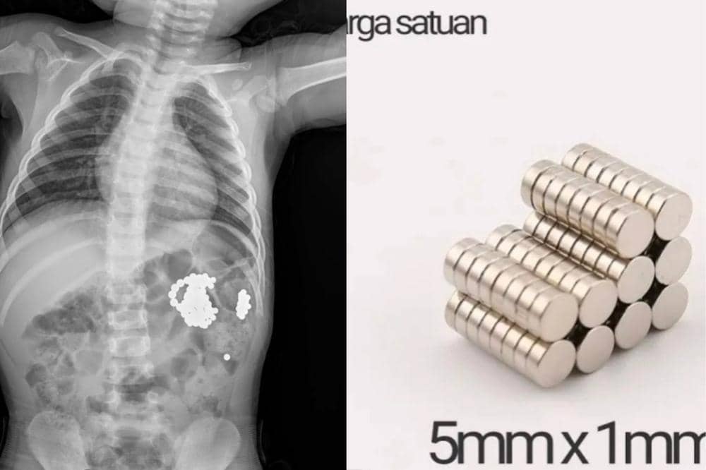 Anak Telan 30 Magnet, dr. Gia Pratama Ingatkan Ini pada Para Orangtua