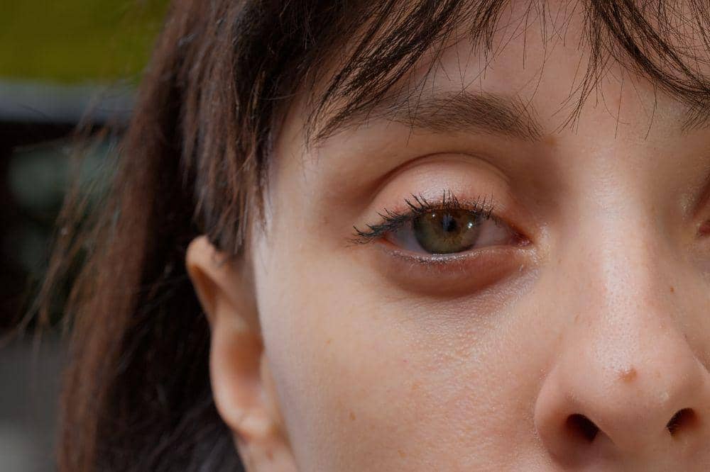 8 Cara Menghilangkan Kantung Mata saat Hamil, Coba Kompres Dingin