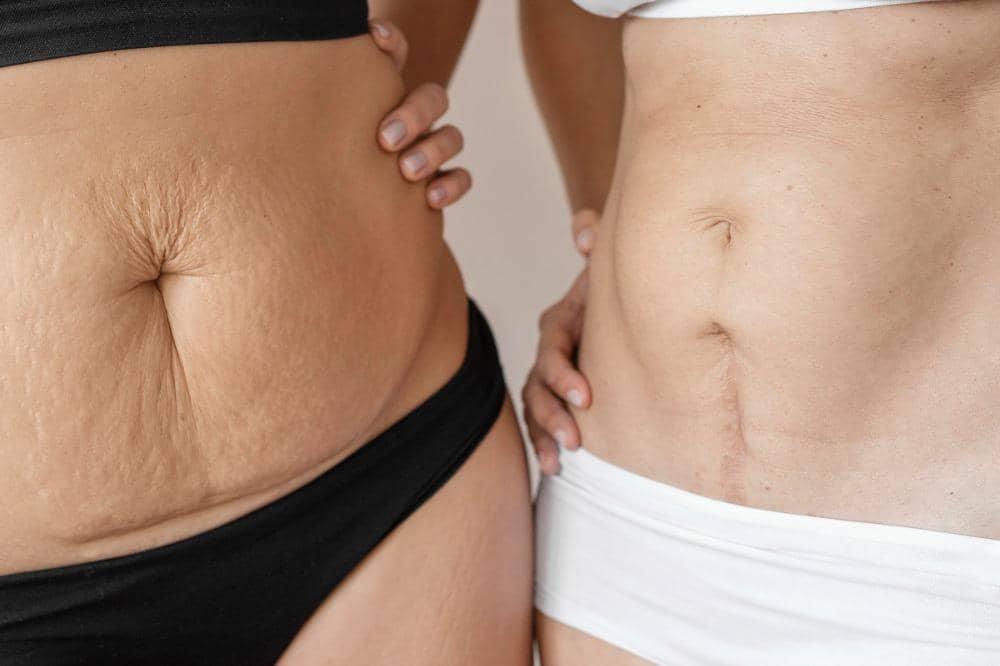 Perubahan Kulit Setelah Melahirkan 7.jpeg