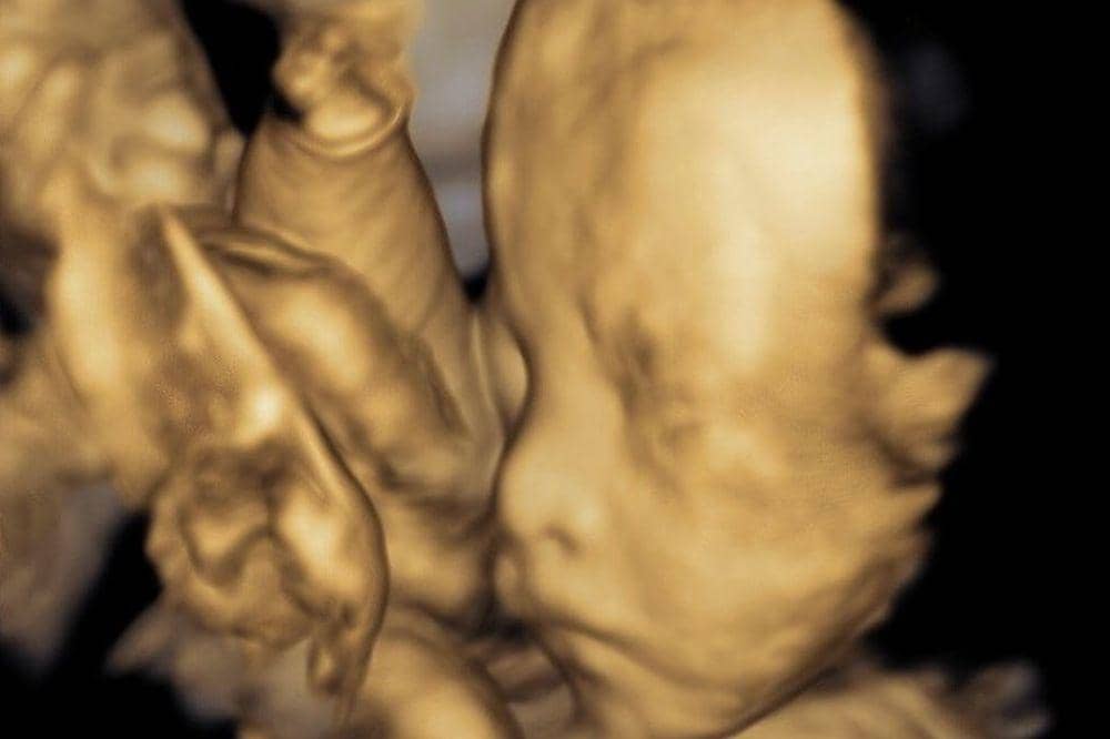 Perjuangan Vior Melahirkan, Sempat Ingin Normal, Berakhir Caesar 4.jpg