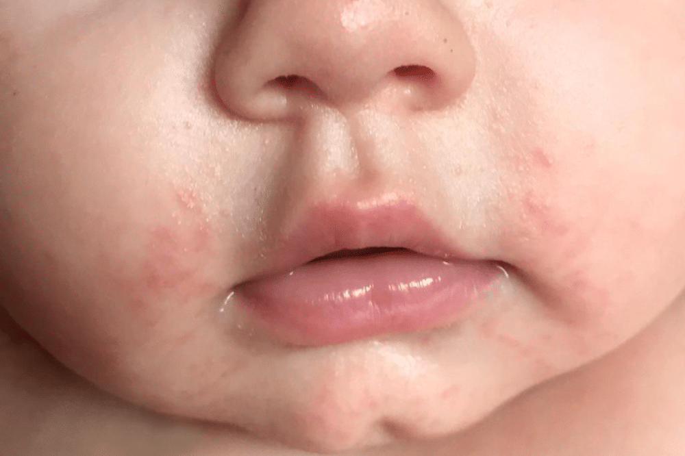 9 Fakta Roseola pada Anak yang Perlu Mama Ketahui