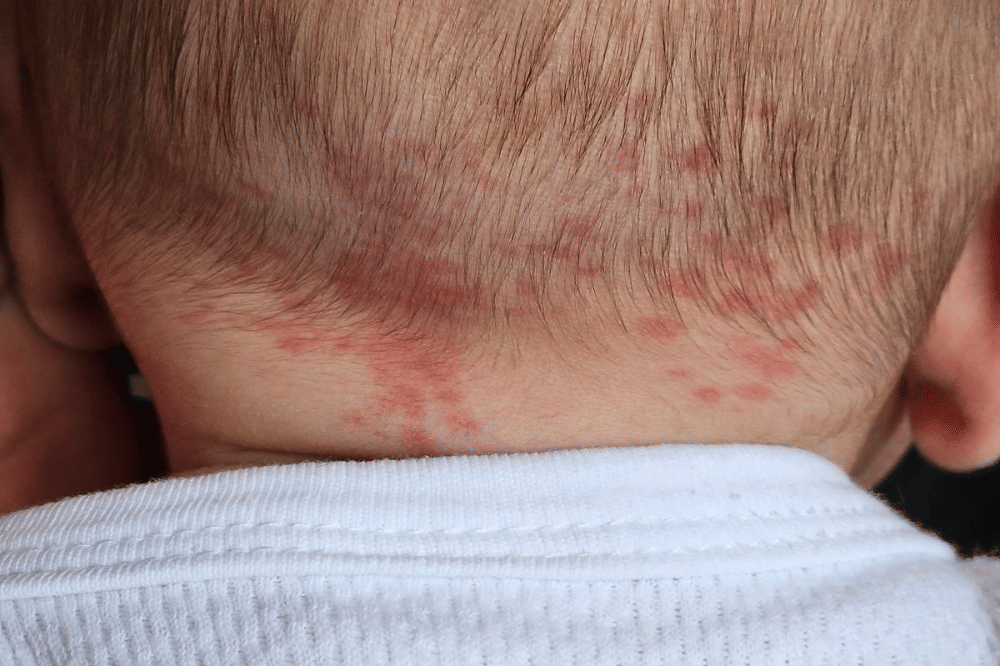 ruam merah pada leher bayi 