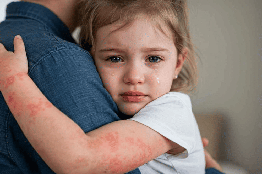 anak perempuan  sedang mengalami ruam merah di lengnnya