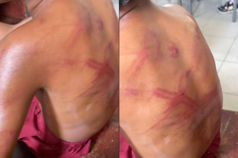 Guru Temukan Luka Lebam Murid, Dipukul Sang Ayah Pakai Kabel Charger