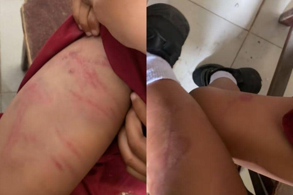 luka lebam murid SD oleh papanya