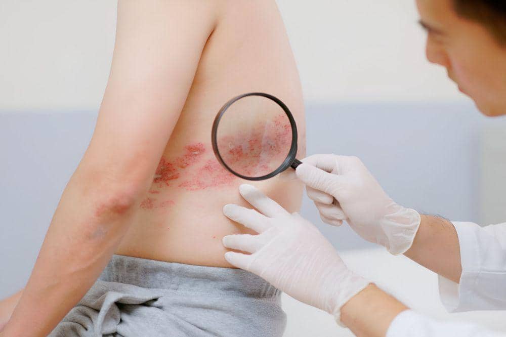 Benarkah Penyakit Kronis Bisa Memicu Cacar Api? Ini Faktanya!