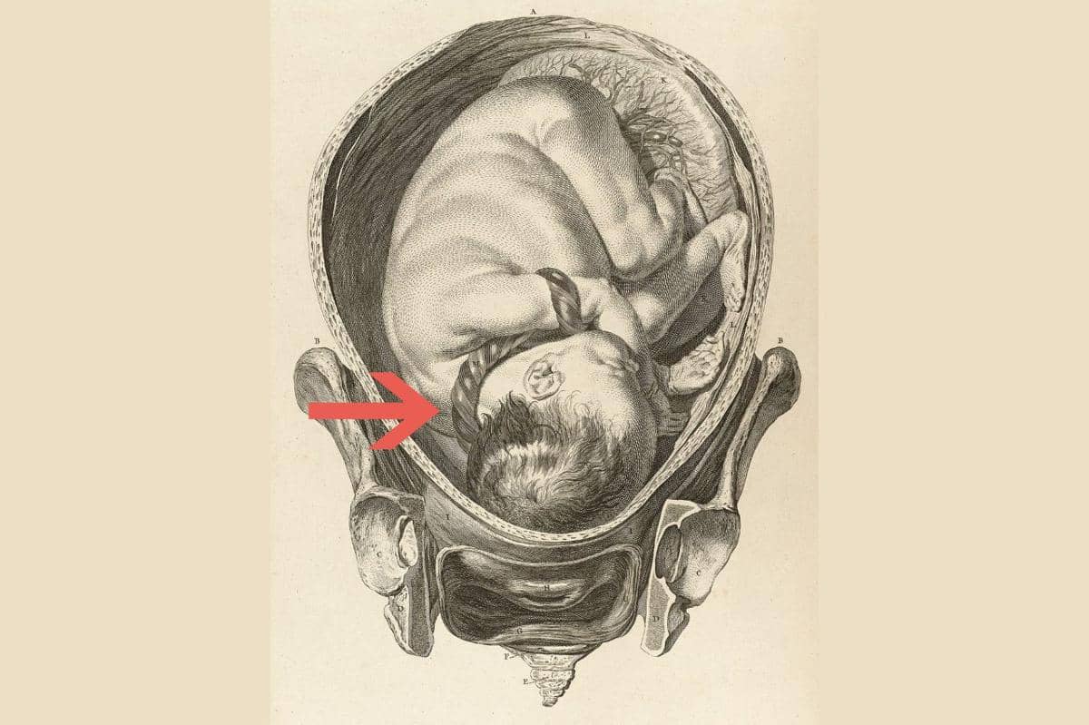 Janin Terlilit Tali Pusar, Apakah Bisa Terlepas dengan Sendirinya?