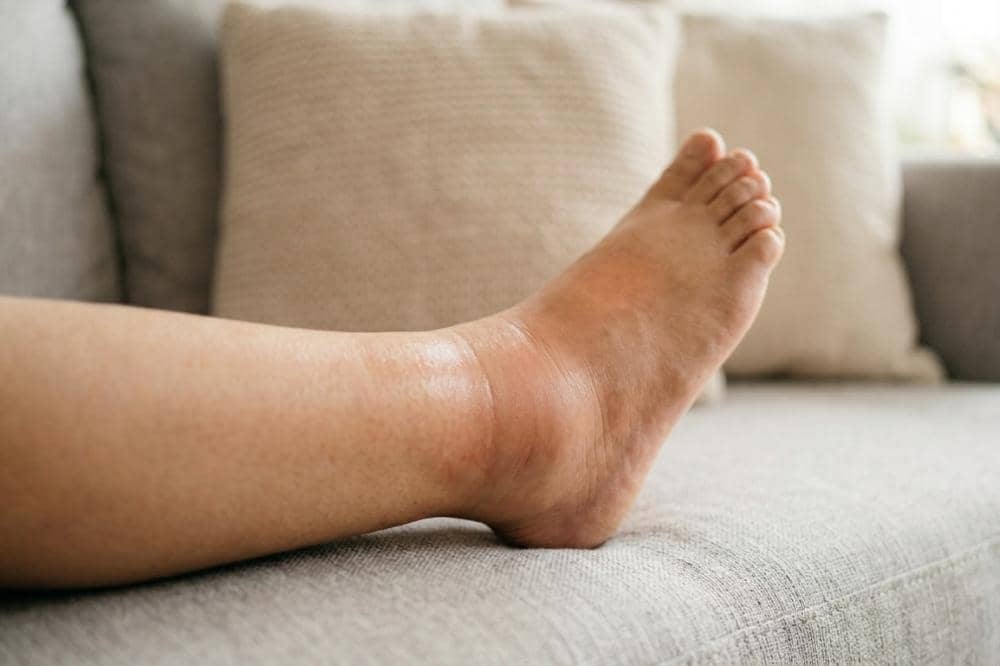 Apa Itu Tissue Edema? Kenali Penyebab dan Gejalanya Sejak Dini 7.jpg