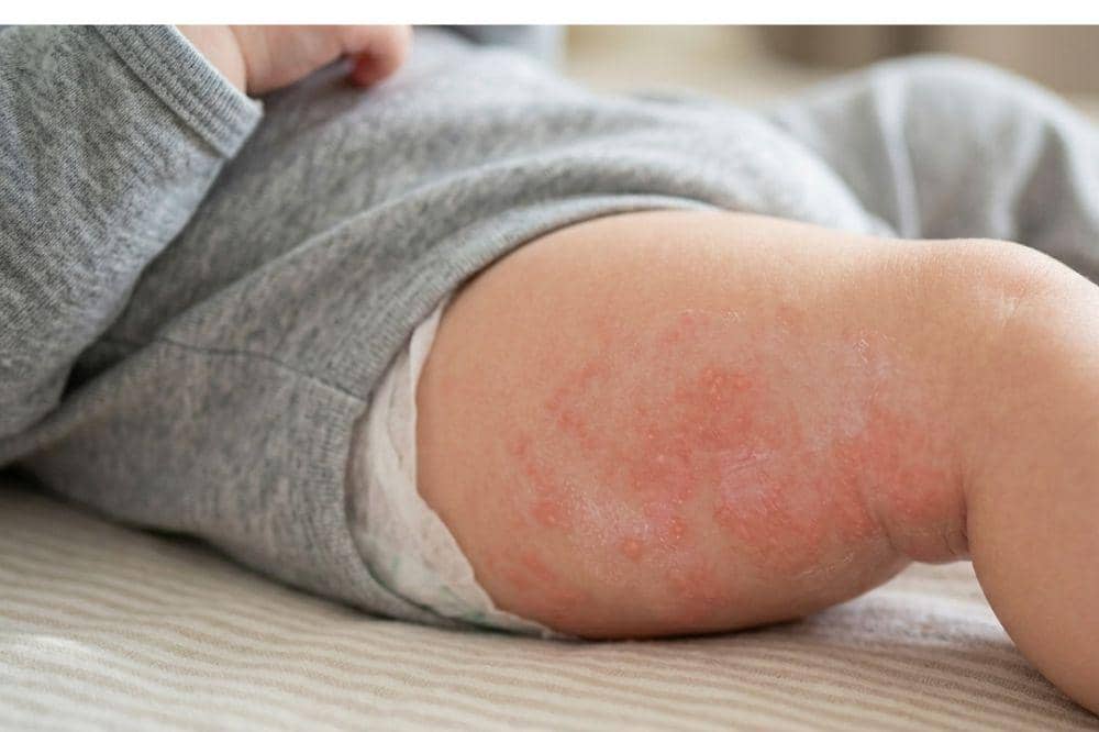 Bayi Mengalami Diaper Rash, Boleh atau Tidak Pakai Popok? Ini Kata Dokter
